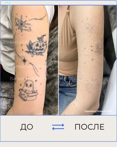 Удаление татуировки